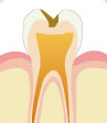象牙質まで進行した虫歯　