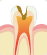 歯の神経まで進行した虫歯　