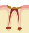 虫歯の末期　